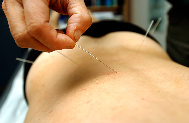 istock Male hand applying acupuncture needles to a person's back 139404879