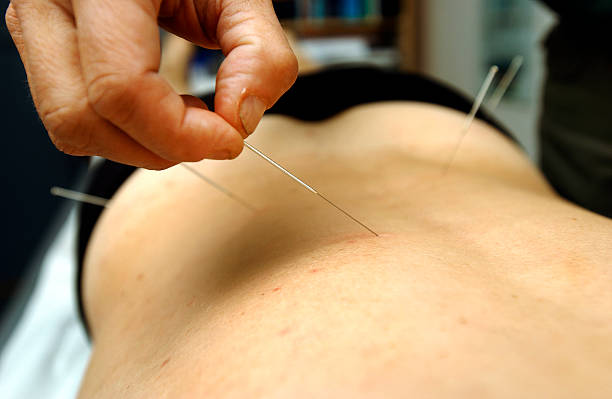Male hand applying acupuncture needles to a person's back stock photo