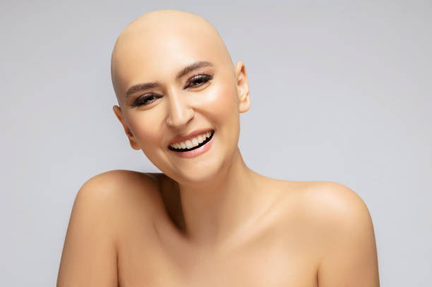 portrait d’une jeune femme avec perte de cheveux à cause du traitement, posant le bonheur après avoir vaincu le cancer. - complètement chauve photos et images de collection