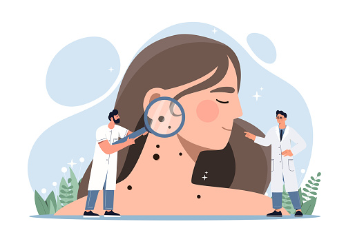 Skin Cancer concept. Doctors with magnifying glasses in their hands examine girl skin and find melanoma in form of mole. Oncology or dermatological problems. Cartoon flat vector illustration