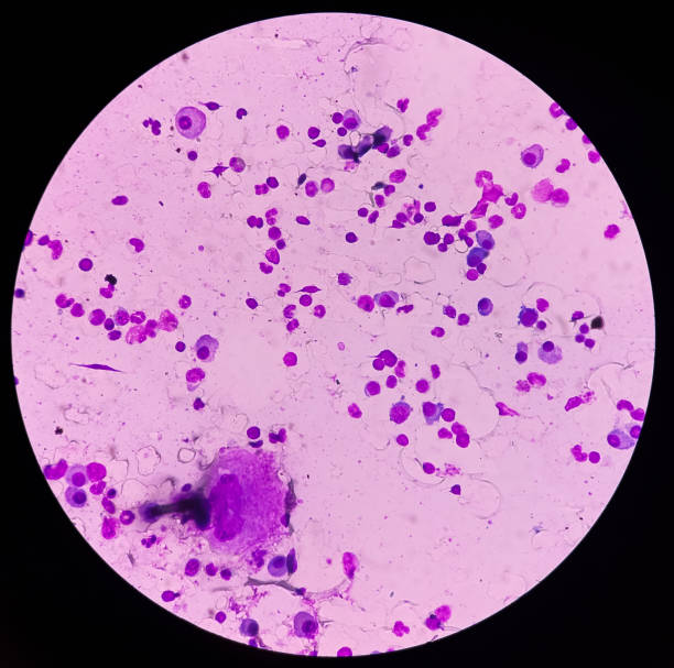 istock Bone marrow study: a megakaryocyte is a large bone marrow cell with a lobated nucleus responsible for the production of blood thrombocytes (platelets). 1394096323