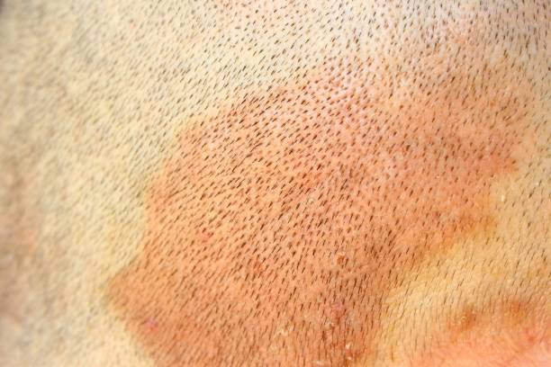 Psoriasis on skinhead Full frame of skinhead psoriasis problem photo skin head stock pictures, royalty-free photos & images