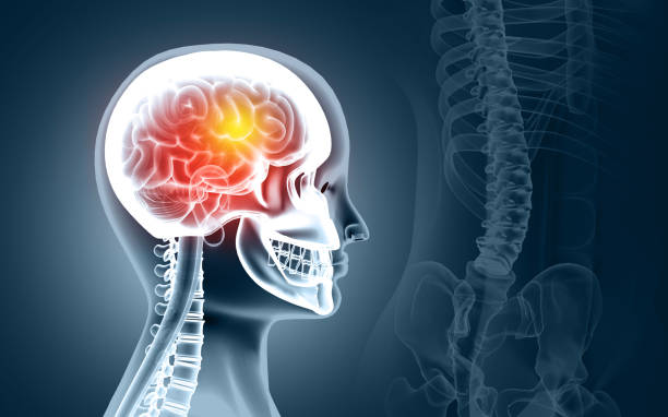 ilustración médicamente precisa de un cerebro doloroso, hombre con dolor de cabeza, estoque, coágulo de sangre en los vasos del cerebro humano, ilustración 3d - stike fotografías e imágenes de stock