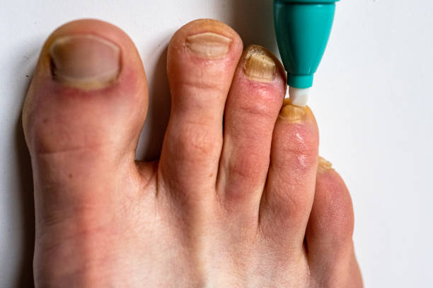 using a pen against nail fungus. nail fungal infection treatment. - fungus toenail human foot onychomycosis imagens e fotografias de stock
