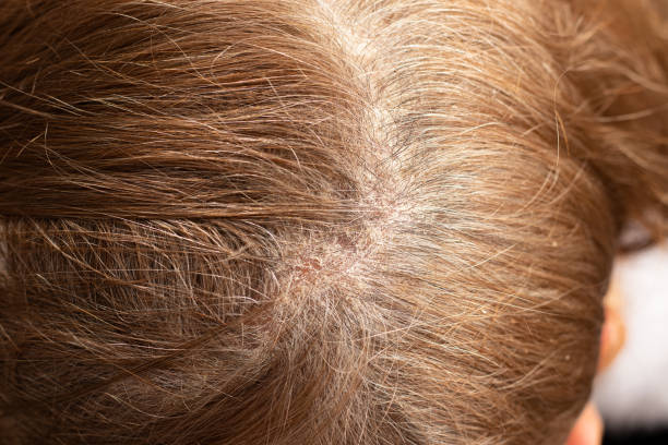 Seborrhea dermatitis condition on female's scalp, a close-up stock photo