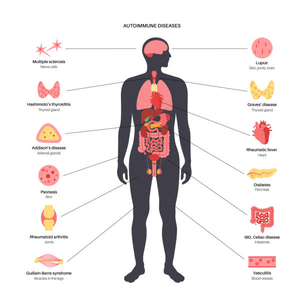 Autoimmune disorders diseases Autoimmune disorders diseases in human body. Symptoms of illness when the immune system attacks joints, blood, skin or internal organs. Medical poster with male silhouette flat vector illustration. human organs stock illustrations