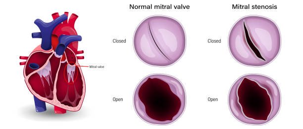 валулярная болезнь сердца. разница между митральным стенозом и нормальным митральным клапаном. - pulmonary valve stock illustrations
