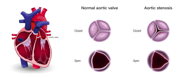 валулярная болезнь сердца. разница аортального стеноза и нормального аортального клапана. - pulmonary valve stock illustrations