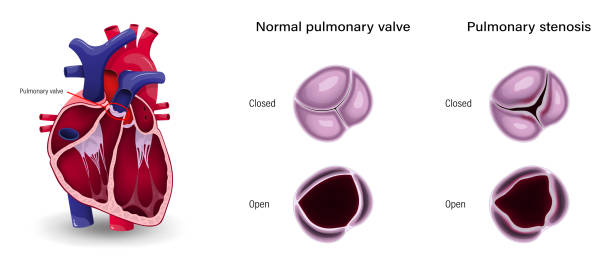 валулярная болезнь сердца. разница легочного стеноза и нормального легочного клапана. - pulmonary valve stock illustrations