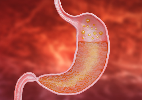 La gastritis es una inflamación del revestimiento interno del estómago que causa dolor intenso, acidez estomacal y ardor. photo