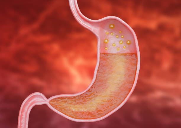 Gastritis is an inflammation of the inner lining of the stomach that causes intense pain, heartburn and burning stock photo