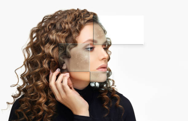 istock Post-Acne Marks Treating Acne Scars.Acne Scar Removal 1394563348