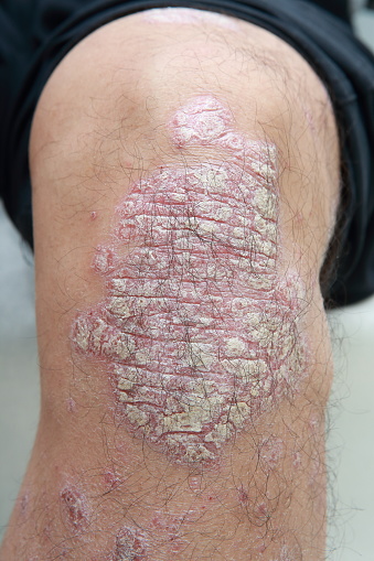 Human skin. inflamed skin. psoriasis. red swollen skin. scab. sensitive skin. skin disease. treatment. medical image. peeling skin. knee