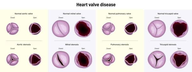 心臓弁膜症。大動脈狭窄症、僧帽弁狭窄症、肺狭窄症および三尖弁狭窄症。 - pulmonary valve点のイラスト素材／クリップアート素材／マンガ素材／アイコン素材