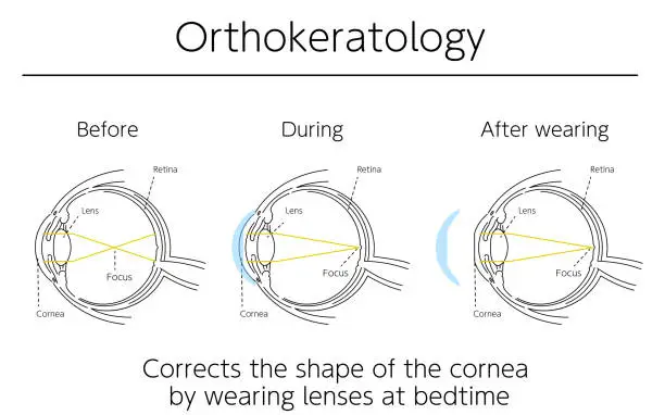 Vector illustration of Illustrations, Correction of vision with orthokeratology, Medical Illustrations.