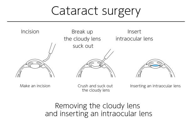 illustrazioni stock, clip art, cartoni animati e icone di tendenza di illustrazioni, chirurgia della cataratta, illustrazioni mediche. - cataratta