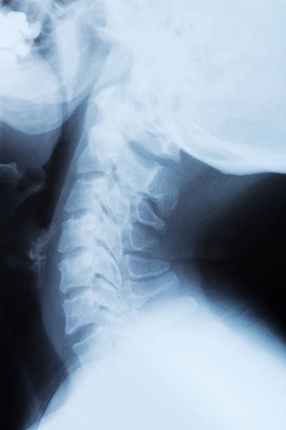 istock Xray of a cervical spine 139483201