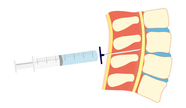 pozycja igły zewnątrzoponowej w kręgosłupie. wstrzyknięcie zewnątrzoponowe za pomocą strzykawki - backache lumbar vertebra human spine posture stock illustrations
