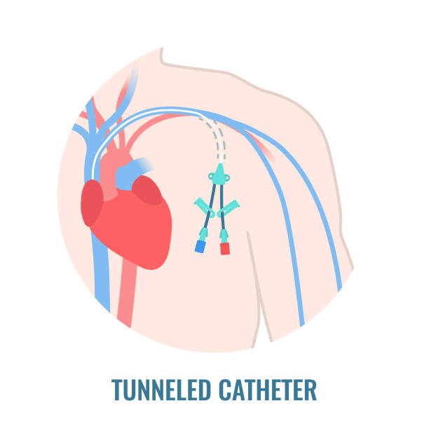 ilustraciones, imágenes clip art, dibujos animados e iconos de stock de catéter venoso de línea central tunelizado de cerca - surgery catheter cardiac catheterization hospital