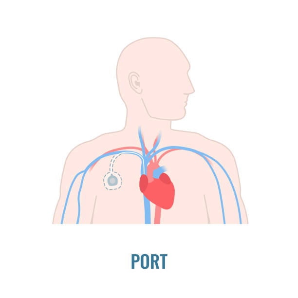 男性の体に埋め込まれた静脈アクセスポート - surgery catheter cardiac catheterization hospital点のイラスト素材／クリップアート素材／マンガ素材／アイコン素材