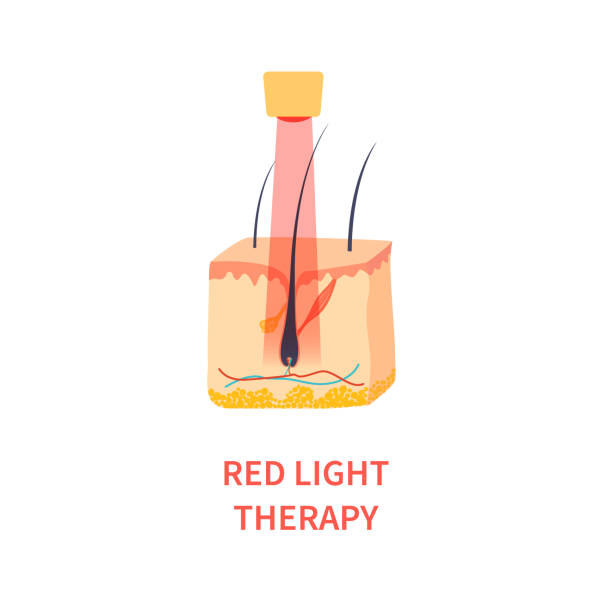 лазерная терапия красным светом лечение алопеции - laser therapy medical laser light therapy stock illustrations