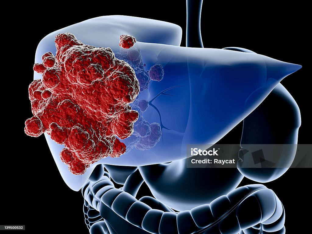 Cancro do fígado - Royalty-free Doença Foto de stock