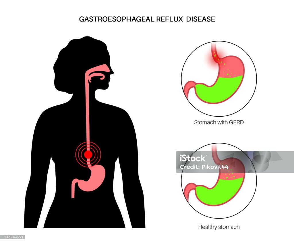 Gerdft Gastroesophageal Reflux Disease Stock Illustration - Download Image Now ...