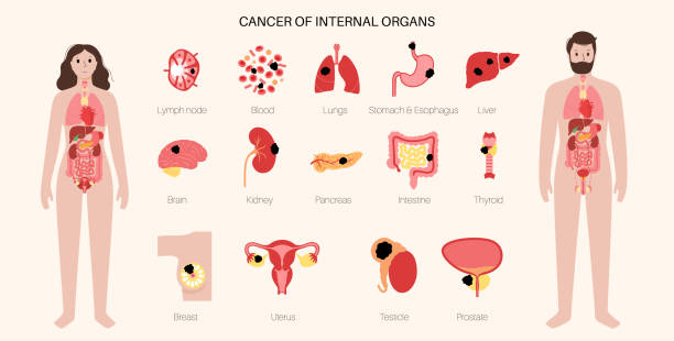 illustrazioni stock, clip art, cartoni animati e icone di tendenza di set di icone per il cancro - lymph node