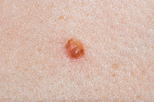 Macro closeup of red swollen boil pimple on leg skin of female woman showing medical condition called hidradenitis suppurativa