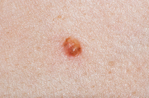 extreme close up of a skin mole - basalcellscancer bildbanksfoton och bilder