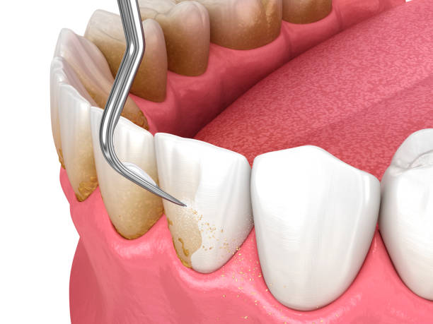 istock Oral hygiene: Scaling and root planing (conventional periodontal therapy). Dental 3D illustration 1395160382