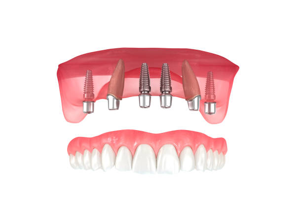 maxillary prosthesis supported by 2 teeth and 4 implants. dental 3d illustration - implantat imagens e fotografias de stock