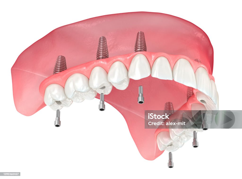 Maxillary prosthesis with gum All on 6 system supported by implants. Dental 3D illustration Implant Stock Photo
