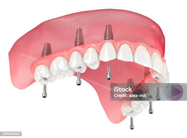 Maxillary Prosthesis With Gum All On 6 System Supported By Implants Dental 3d Illustration Stock Photo - Download Image Now