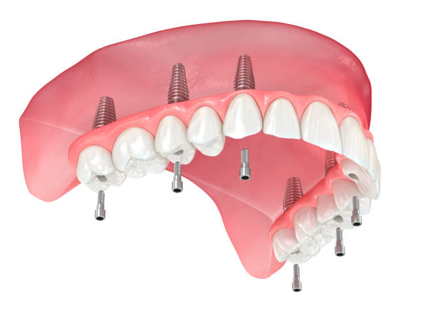 maxillary prosthesis with gum all on 6 system supported by implants. dental 3d illustration - implantat imagens e fotografias de stock