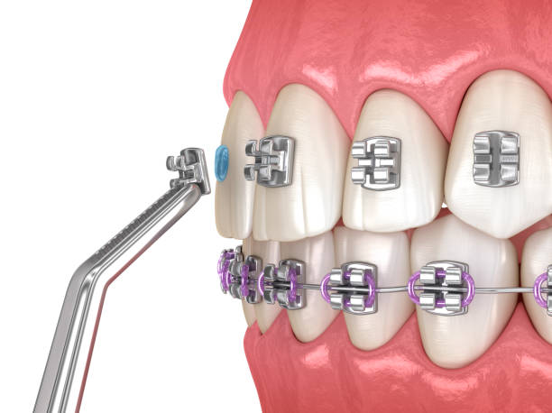 istock Metal braces installation process. Dental 3D illustration 1395160479
