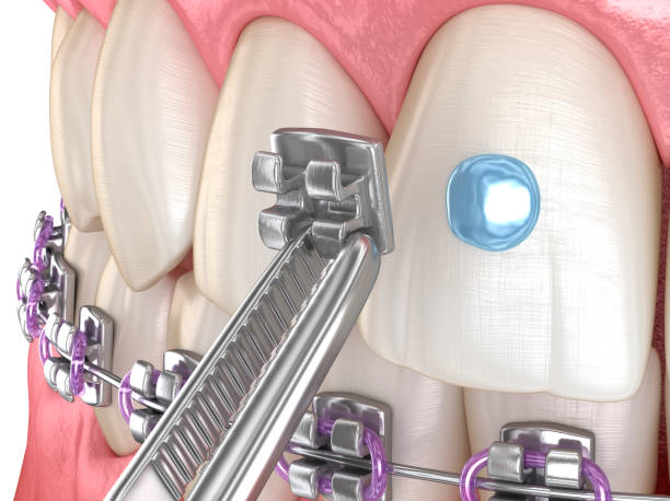 istock Metal braces installation process. Dental 3D illustration 1395160484