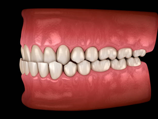 istock Underbite dental occlusion ( Malocclusion of teeth ). Dental 3D illustration 1395160491