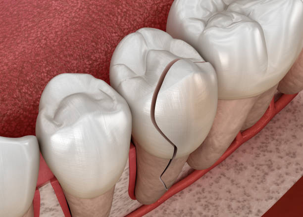 istock Cracked tooth, splitted. Dental 3D illustration 1395160503