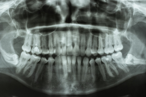 Close-up of panoramic dental CAT scan. Abnormal location of molar teeth on lower jaw area.