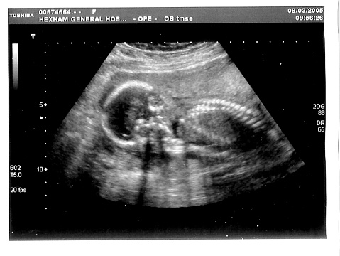 ultrasound baby scan