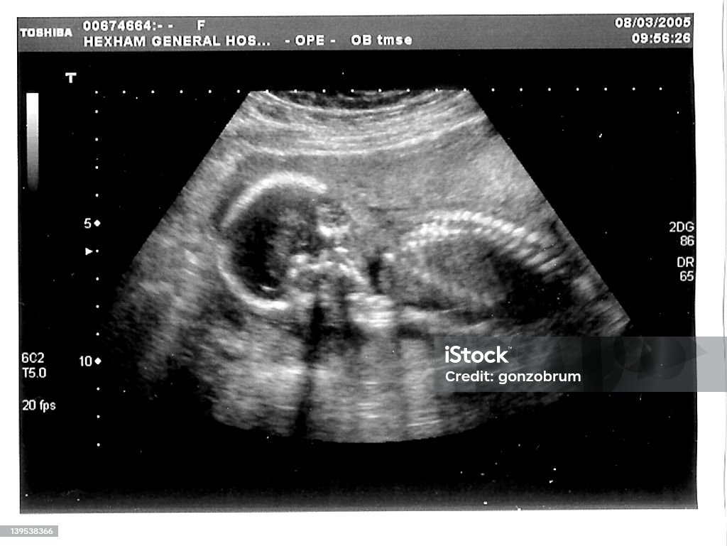 Meu babys 19 semana scan - Foto de stock de Cabeça Humana royalty-free