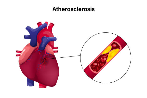 miażdżyca z koncepcją wektora serca. choroba wieńcowa. przyczyny niedokrwienia mięśnia sercowego. - human artery cholesterol atherosclerosis human heart stock illustrations