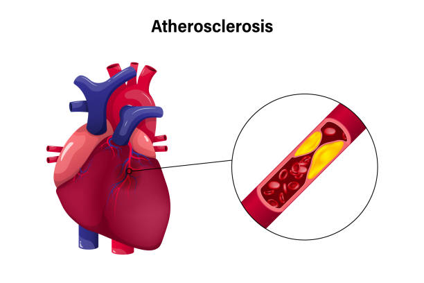 атеросклероз с концепцией сердечного вектора. ишемическая болезнь сердца. причины ишемии миокарда. - human artery cholesterol atherosclerosis human heart stock illustrations