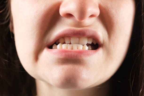 istock Patient with dislocated jaw and malocclusion, temporomandibular joint dysfunction, close-up. 1395539303