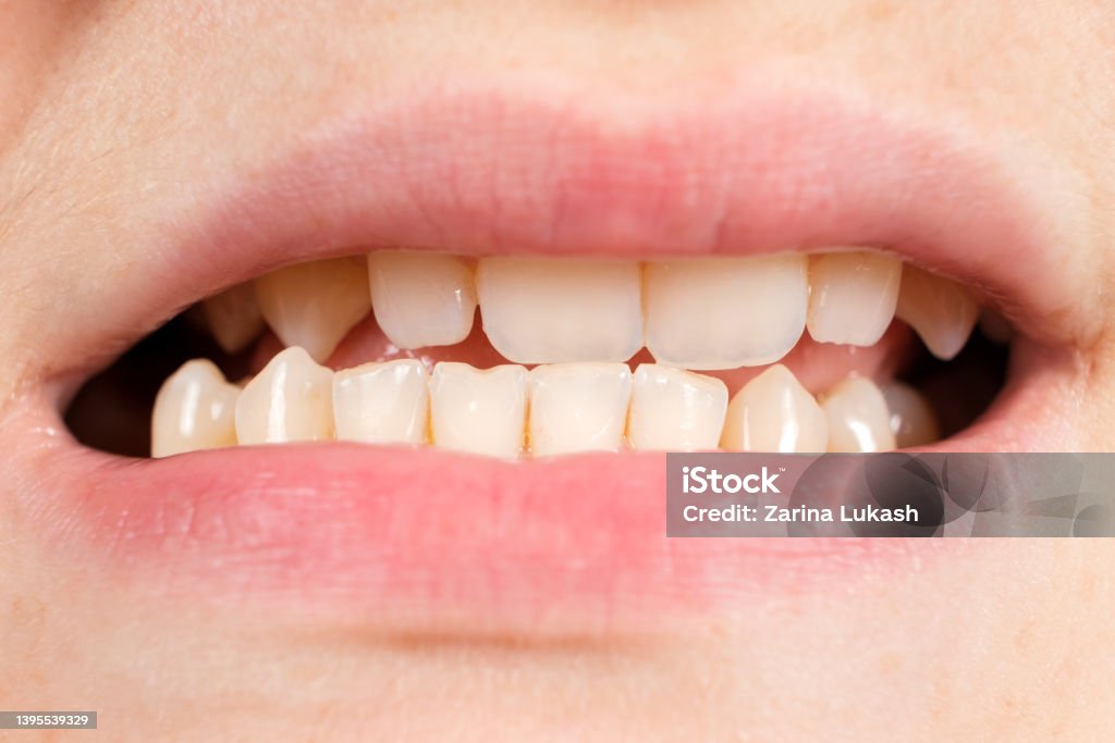 Patient with dislocated jaw and malocclusion, temporomandibular joint dysfunction, close-up. Patient with dislocated jaw and malocclusion, temporomandibular joint dysfunction, close-up Malocclusion Stock Photo