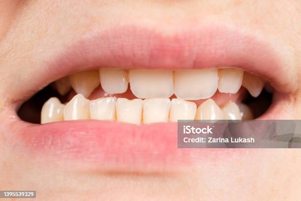 Patient With Dislocated Jaw And Malocclusion Temporomandibular Joint Dysfunction Closeup Stock Photo - Download Image Now