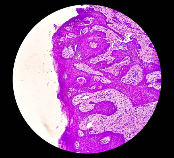 피부암: 기저 세포 암종을 보여주는 miicroscope에 의한 피부 생검. - 기저세포암종 뉴스 사진 이미지