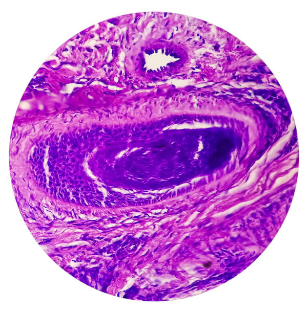 cáncer de piel: biopsia de piel bajo miicroscopio que muestra carcinoma de células basales. - human tissue histology dermatology human skin fotografías e imágenes de stock