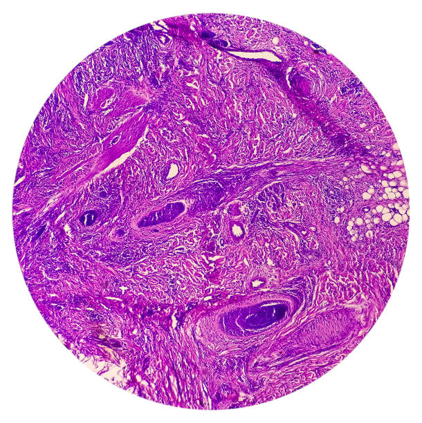 cáncer de piel: biopsia de piel bajo miicroscopio que muestra carcinoma de células basales. - human tissue histology dermatology human skin fotografías e imágenes de stock